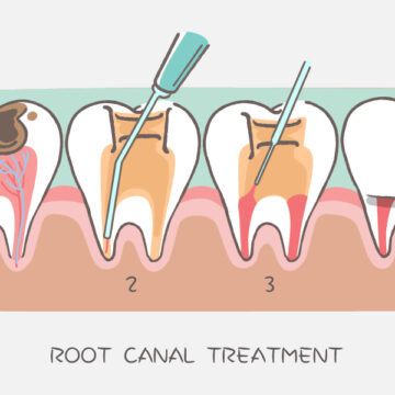 Root Canal Therapy