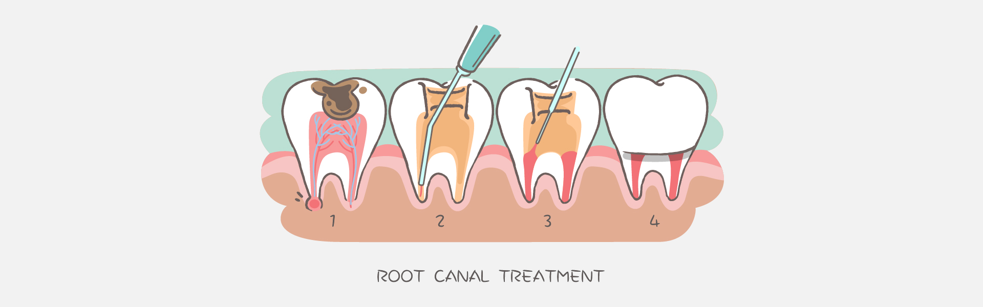 Root Canal Therapy