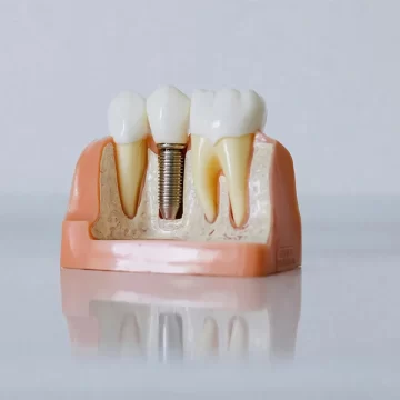 Dental Implants in converse