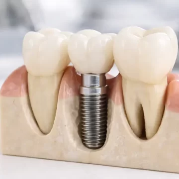 How Do Dental Implants Restore Missing Teeth Long-Term?